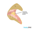 Yellow caseous canker lesions in the mouth of a chicken
